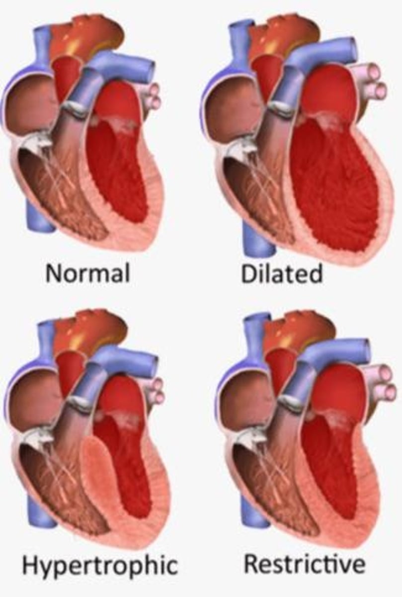 <p>Thickened heart wall; impairs relaxation and filling.</p>