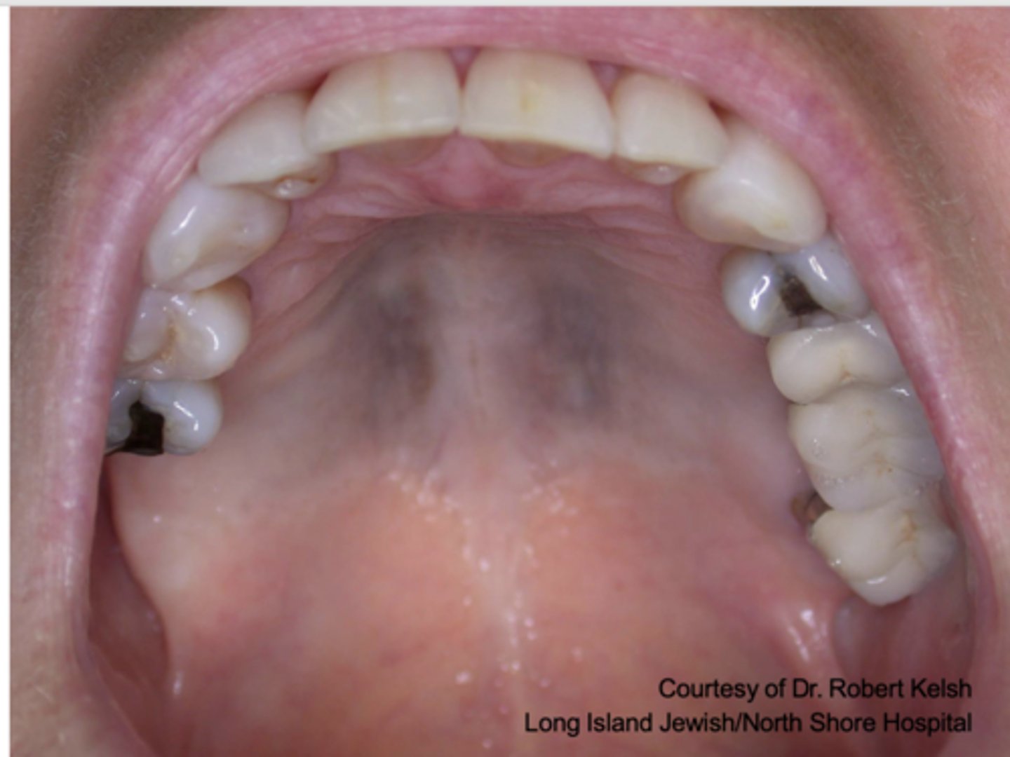 <p>What type of pigmented lesion?</p>
