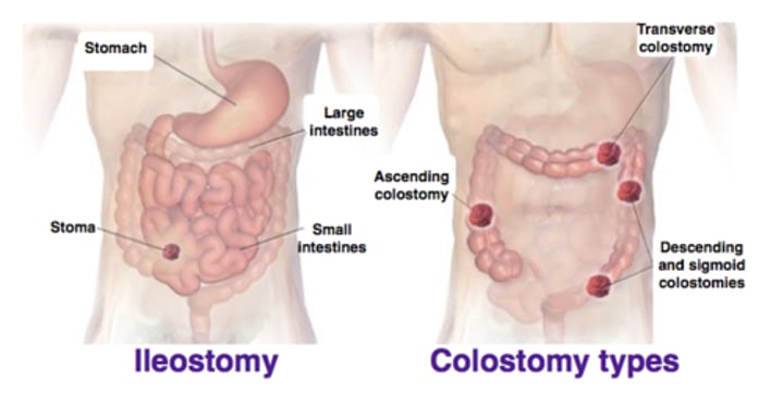 <p>When the end of the small bowel (ileum) or loop of the ileum is brought out onto the right side of the abdominal wall, resulting in a stoma</p>