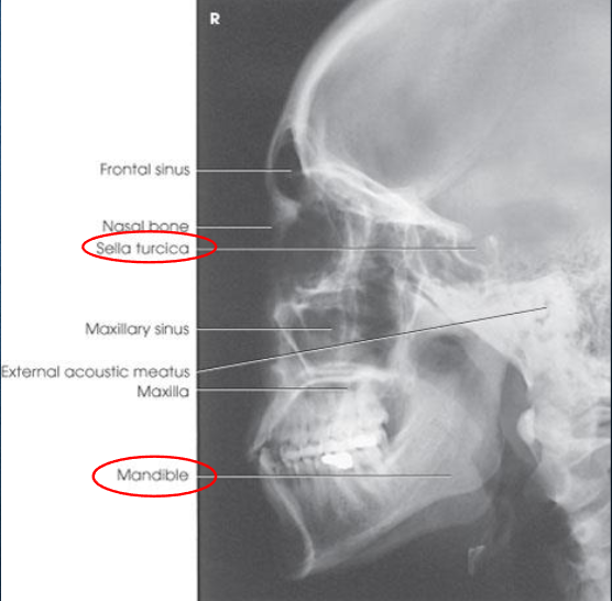 <ul><li><p>right and left sides superimposed</p></li><li><p>all facial bones in entirety with zygomatic bone centered</p></li><li><p>no rotation or tilt:</p><ul><li><p>almost perfectly superimposed mandibular rami</p></li><li><p>superimposed orbital roofs</p></li><li><p>sella turcica in profile</p></li></ul></li></ul><p></p>