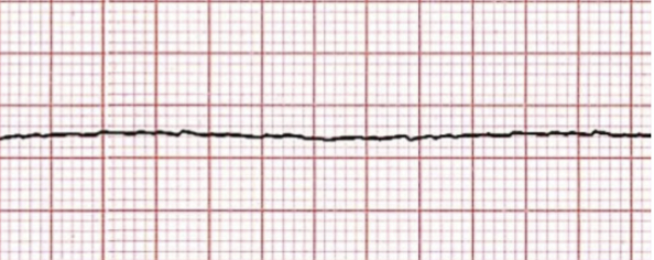 <p>Identify the rhythm! Discuss nursing and collaborative care</p>