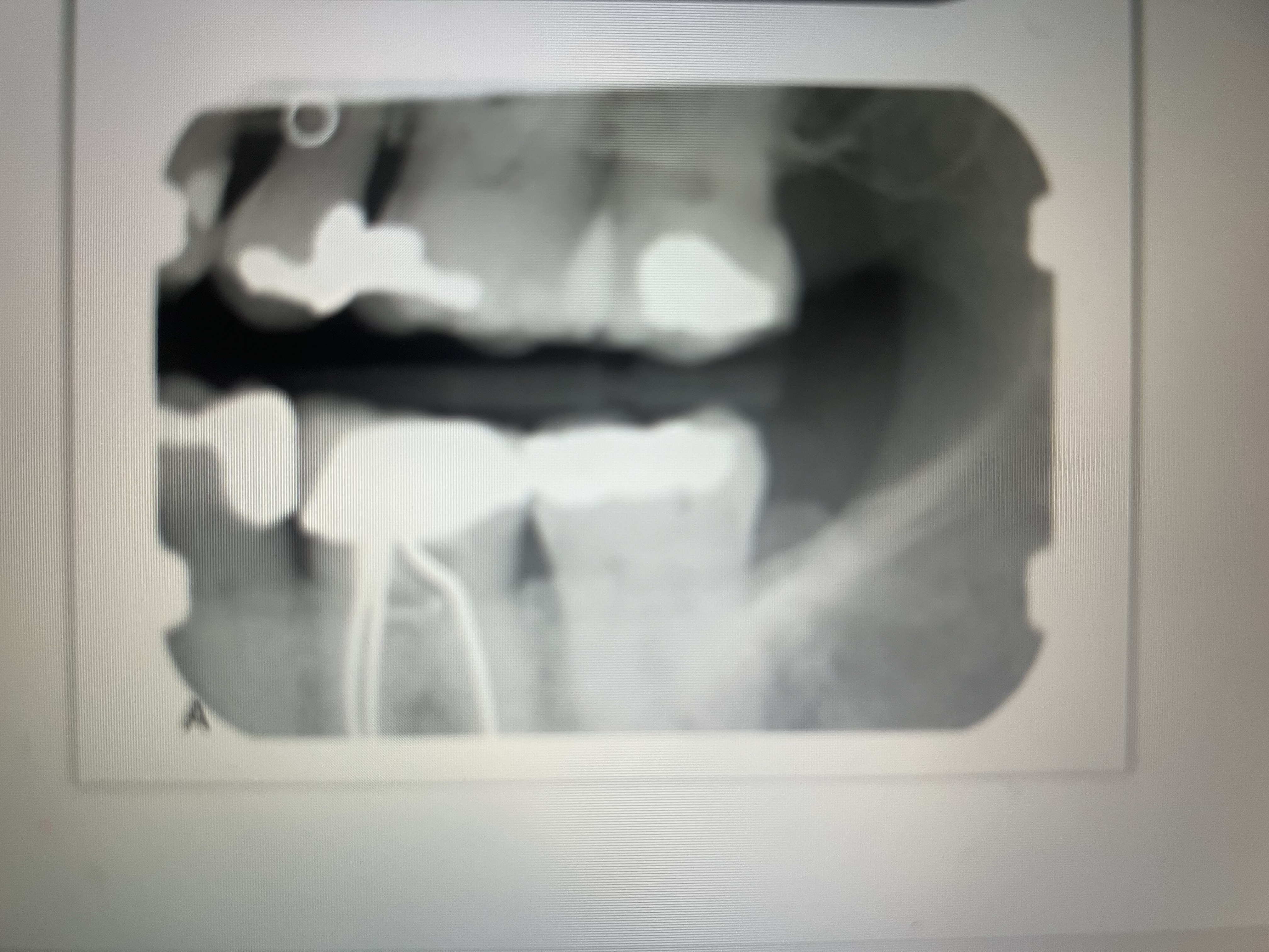 <p>Highly radiopaque</p>