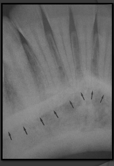 <p>-Radio opaque band</p><p>-It looks like an upside down V.</p><p>-Runs from the premolar region to the incisal region of the mandible</p>