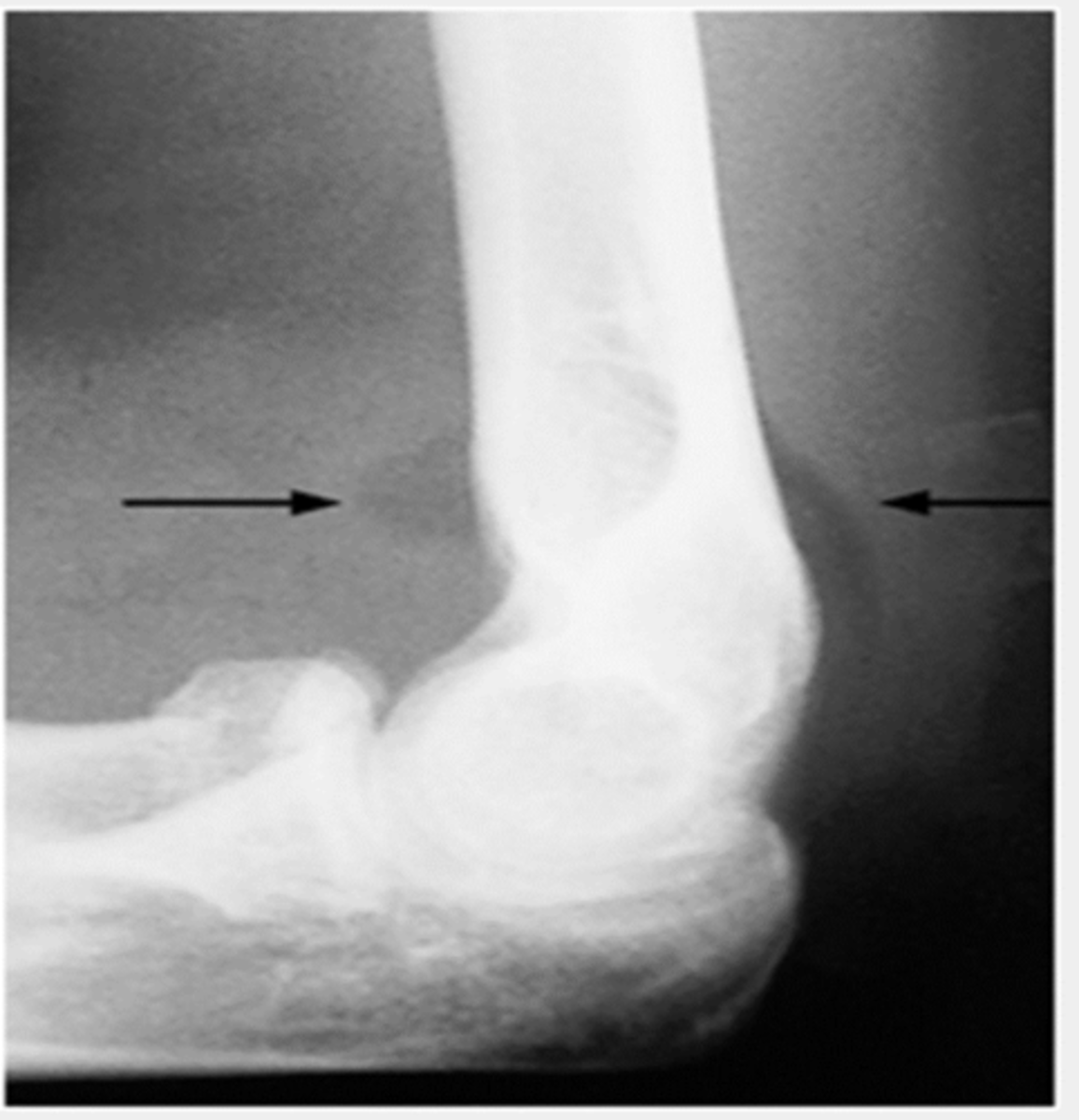 <p>Bleeding that is not visible.</p>