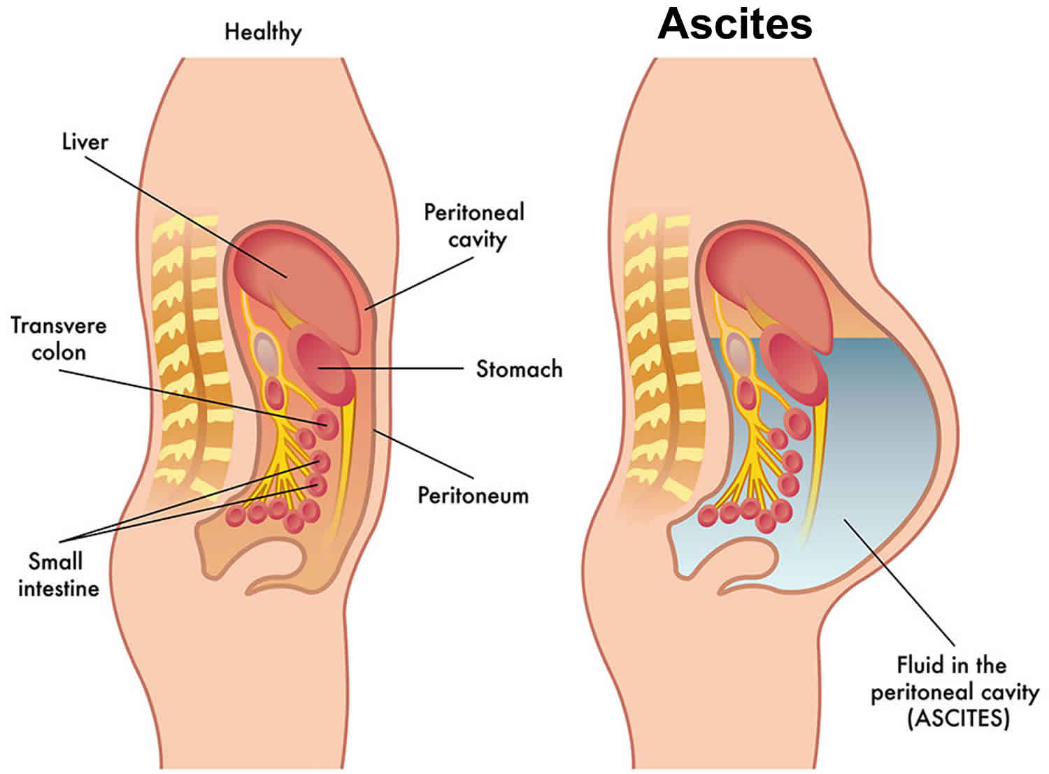 Abnormal accumulation of serous fluid in the peritoneal cavity 