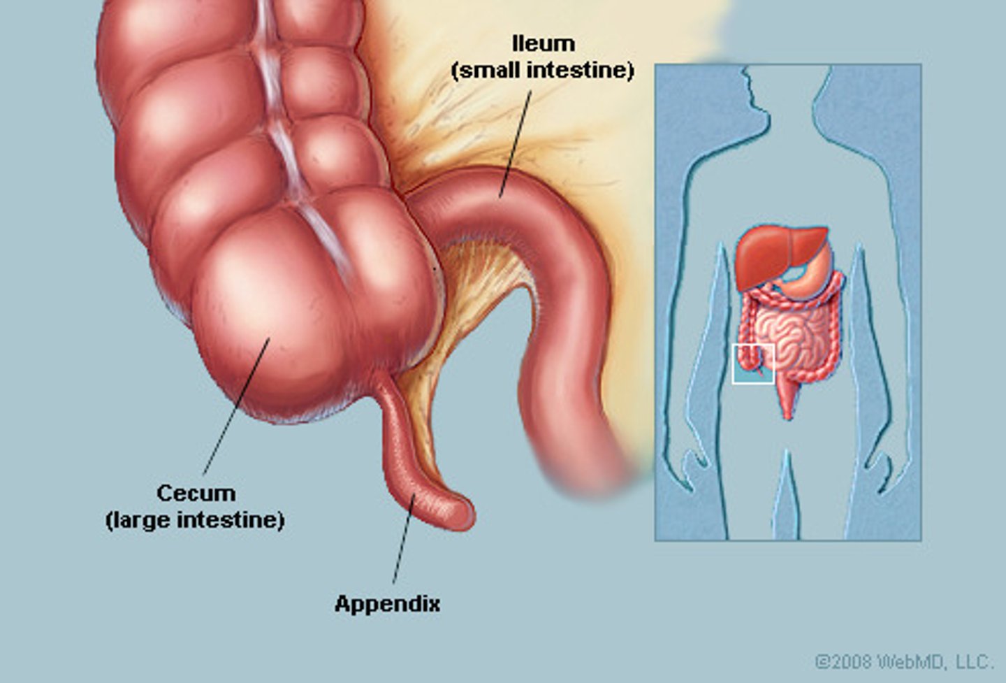 <p>Inflammation of the appendix</p>