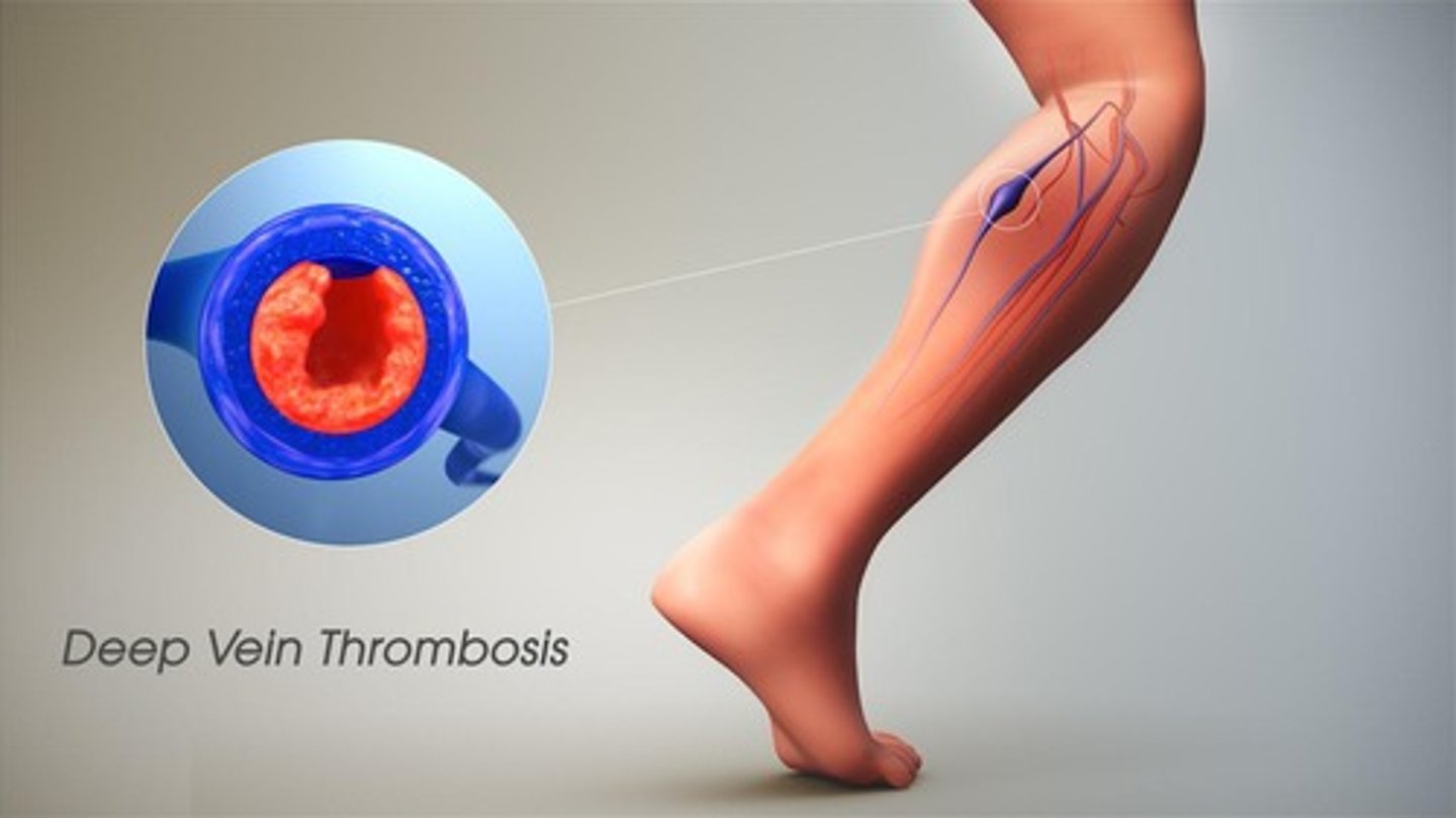 <p>Obstruction of blood vessels by clots.</p>