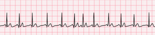 <p>Determine the atrial dysrhythmia:</p><p>Different P wave shapes with more than 100 bpm rate, irregular</p>