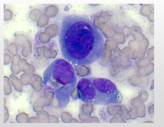 <p>Criteria of malignancy - Nuclear Features</p><p>Describe the cell - malignant or no? Why?</p>