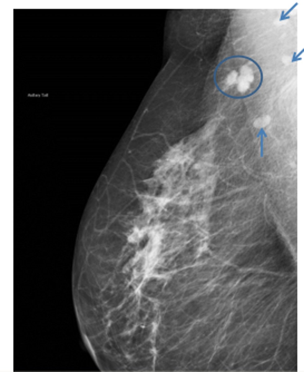 <p>x-ray recording of the breast</p>