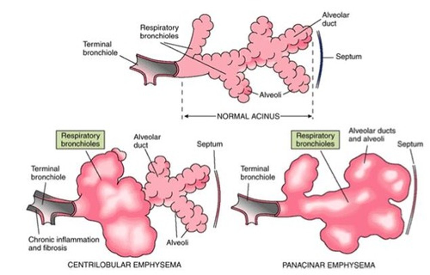 <p>Weakening of respiratory bronchioles, linked to smoking.</p>