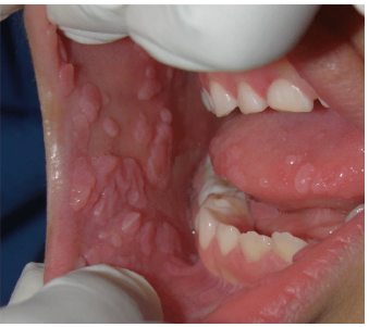 <p>What lesion is this?</p>