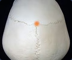 <p>Ectocranial point where the coronal and sagittal sutures intersect</p>
