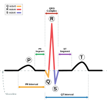 <p>The <strong>P wave</strong> represents the depolarization of the atria. </p><p>The <strong>QRS complex</strong> represents the depolarization of the ventricles. It is much larger than the P wave because the atria are smaller than the ventricles, so there are fewer cells to depolarize in the atria. </p><p>The <strong>T wave</strong> represents the repolarization of the ventricles. </p><p>The <strong>U wave</strong> is not always seen, but it may be the repolarization of Purkinje fibers (in the ventricles of the heart). </p>