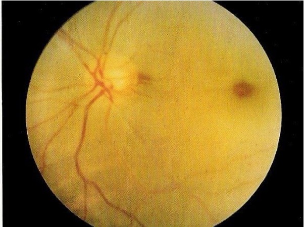 <p>What is this patient likely experiencing?</p><p></p><p>Sudden, painless, monocular loss of vision</p><p>The patient is 75 and has a history of stroke</p><p>The patient thinks they had some black spots in their vision a few days ago, but can’t remember very well</p><p>Affected eye has gone totally “black”, i.e. patient cannot see any light</p><p>Affected eye demonstrates RAPD</p>