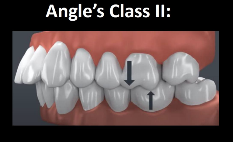<p>the MB cusp of max 1st is situated over the embrasure btwn the mand 2nd PM and 1st molar</p>