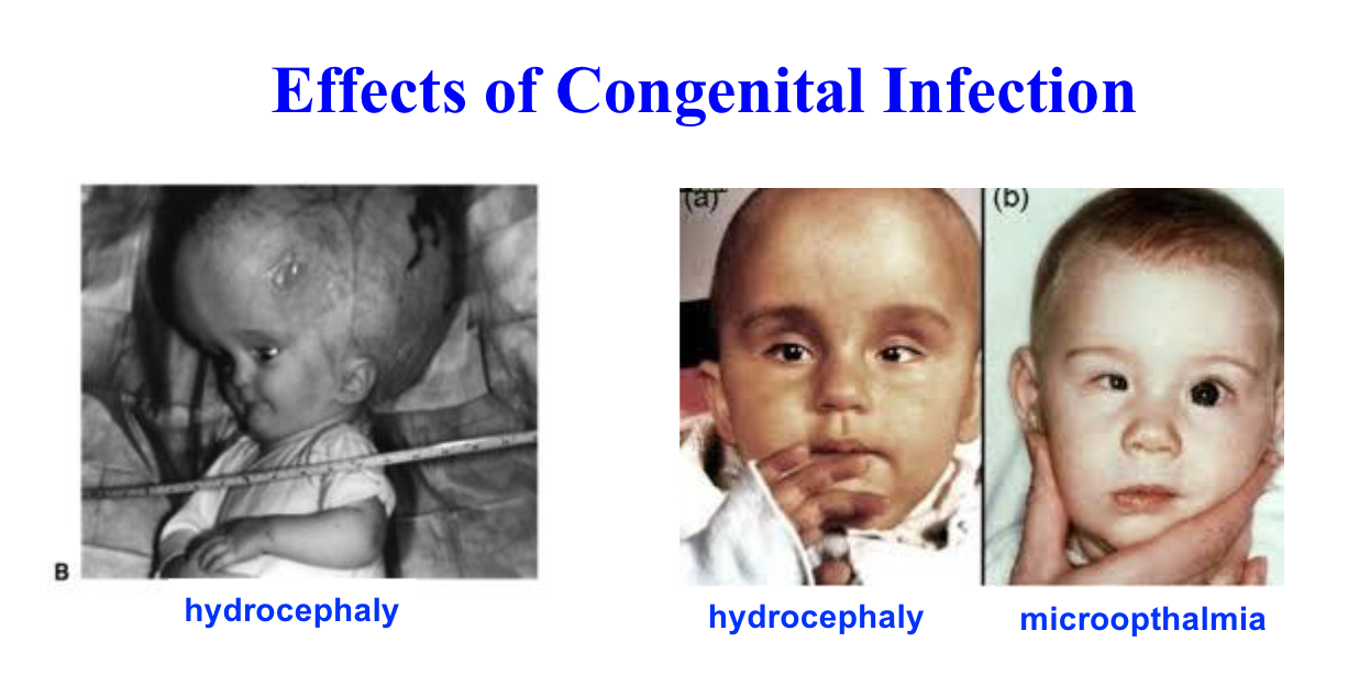 <p>retinochoroiditis (iinflammation at back of eye)</p><p>microopthalmia</p><p>mental retardation</p><p>hydrocephaly</p><p>spontaneous abortion (miscarriage)</p>