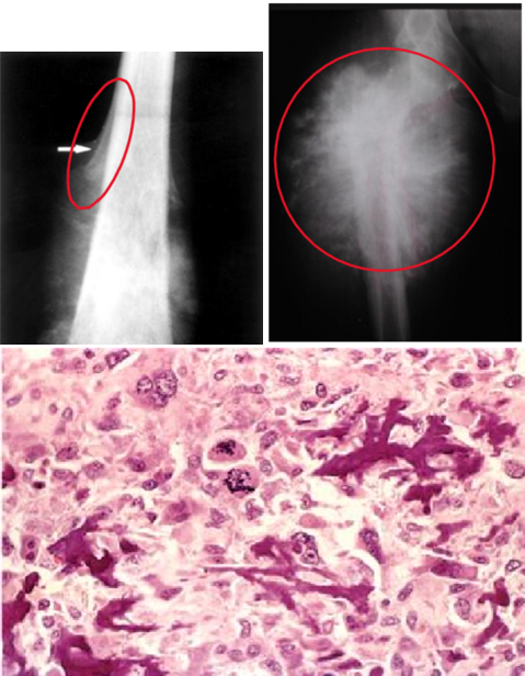 <p>most <strong><span style="color: red">common primary bone cancer</span></strong> arises in the <strong><span style="color: red">metaphyseal cancellous bone &amp; lifts the periosteum → Codman triangle</span> on X-ray &amp; <span style="color: red">sunburst</span> also seen X-ray</strong></p><ul><li><p>mainly affects <strong><mark data-color="green">young males</mark></strong> <mark data-color="blue">around </mark><strong><span style="color: red"><mark data-color="blue">knee area (distal femur or proximal tibia)</mark></span></strong><mark data-color="blue"> presenting with </mark><strong><mark data-color="blue">pain &amp; progressive swelling</mark></strong></p></li><li><p>seen in <strong><mark data-color="green">older males</mark> <mark data-color="blue">with predisposing factors: </mark><span style="color: red"><mark data-color="blue">Paget disease, bone infarcts, &amp; prior radiation (secondary type)</mark></span></strong></p></li><li><p>associated with</p><ul><li><p><strong><mark data-color="purple">RB gene - retinoblastomas (white reflex in eyes)</mark></strong></p></li><li><p><strong><mark data-color="purple">TP53 - Li-Fraumeni syndrome</mark></strong></p></li><li><p>INK4a, MDM2, CDK4</p></li></ul></li></ul><p>clinical presentations</p><ul><li><p><strong>large bulky tumors that often contains areas of hemorrhage &amp; cystic degeneration</strong></p></li><li><p>tumor cells: <strong><mark data-color="blue">very in size &amp; shape (pleomorphic) &amp; frequently have large hyperchromatic nuclei</mark></strong></p><ul><li><p><strong>osteoblastic type can produce bone</strong></p></li></ul></li></ul><p>treatments</p><ul><li><p><strong><mark data-color="purple">chemotherapy followed by surgery</mark></strong></p></li><li><p>with treatment: 5-year disease-free survival rate 60 - 70%</p></li><li><p>< 20% 5-year survival rate with overt metastasis or recurrent disease</p></li></ul>