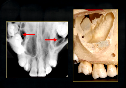 <p>occlusal view shows how maxillary air sinus varies in size </p>