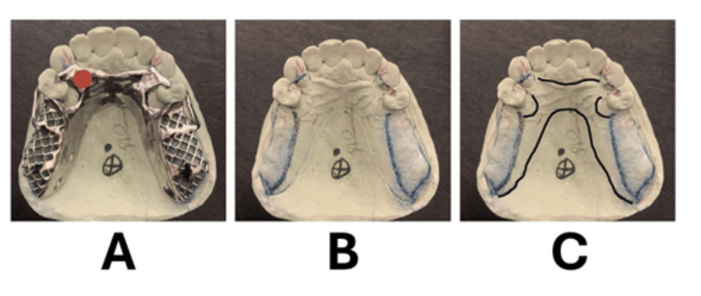 <p>A. there are a total of four rest seats in this design</p><p>B. some rest seats function to provide the indirect retention needed in this design</p><p>C. provide sufficient space for the cast rest to fill the missing tooth structure and have adequate bulk for rigidity</p><p>D. some rests are shaped to allow rotation of the cast rests for this RPD design</p><p>ALL</p>