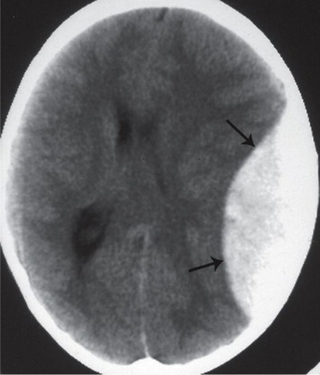 <p>-white lens shape</p><p>-falx cerebri is pushed to one side</p>