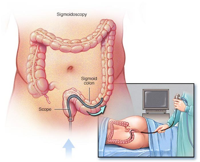 <p>Nội soi đại tràng (ruột già) sigma bằng ống dẻo</p>
