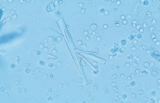 Sulfonamide crystals, along with WBCs and bacteria