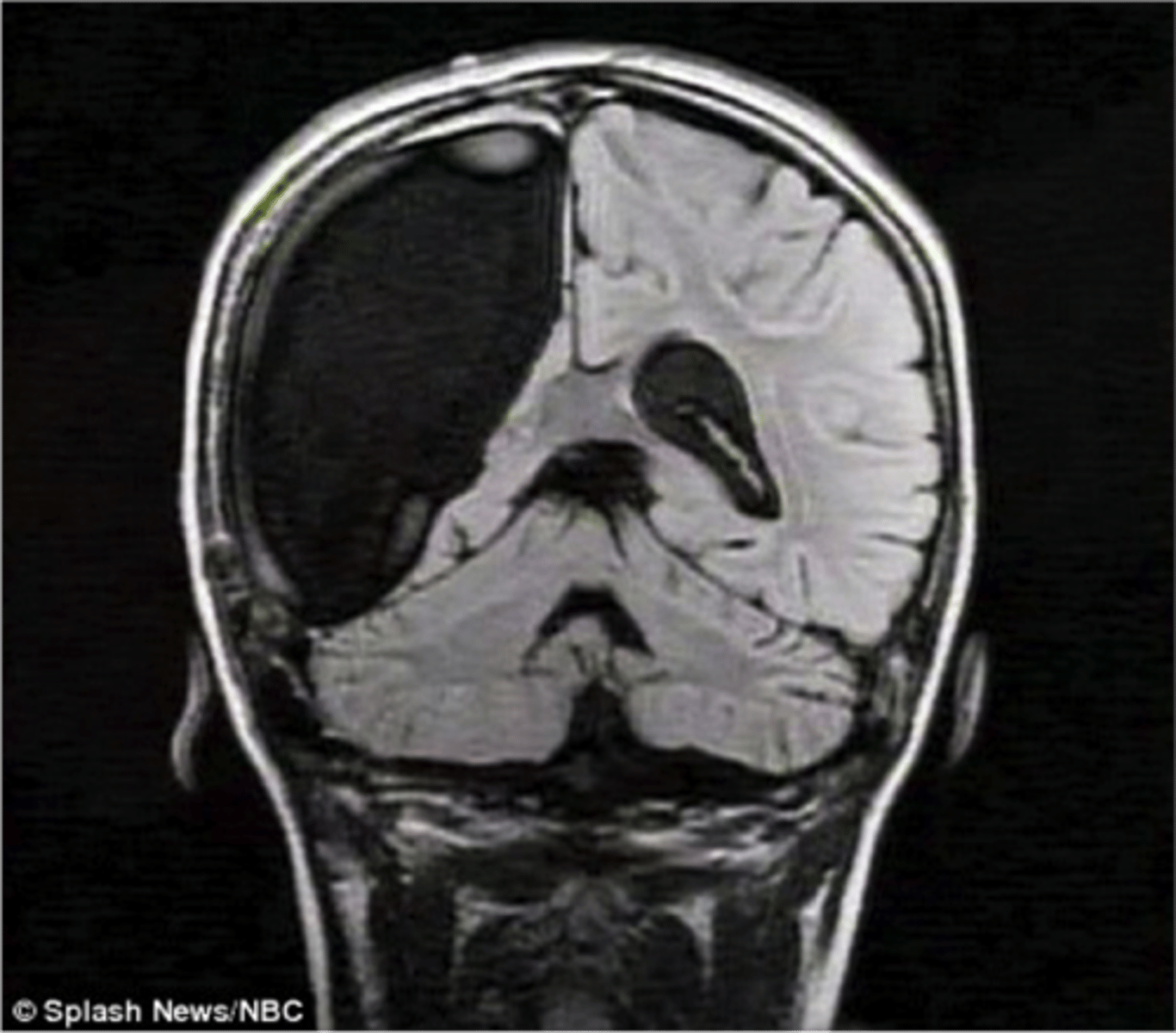 <p>A rare and complex surgical procedure where one hemisphere of the brain is either partially or completely removed</p>