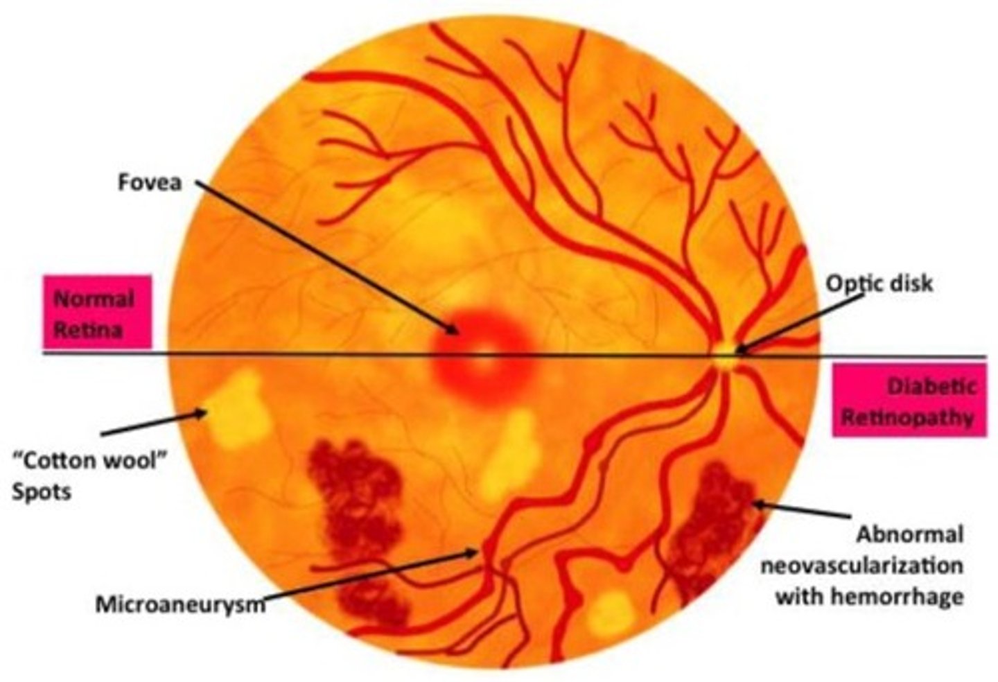 <p>Define Condition:</p><p>-Path: AGEs, oxidative stress, sorbitol accumulation -&gt; damage small blood vessels of the retina</p><p>-Dx: Fundoscopy</p><p>&gt; Early = Non-Proliferative</p><p>&gt;&gt; Microaneurysms</p><p>&gt;&gt; Blot Hemorrhages (rupture of microaneurysms)</p><p>&gt;&gt; Hard exudates --&gt; Capillary leakage --&gt; lipid deposits</p><p>&gt;&gt; Cotton wool spots = areas of retinal ischemia</p><p>&gt; Late = Proliferative</p><p>&gt;&gt; Neovascularization (attempt to compensate for poor blood supply)</p>