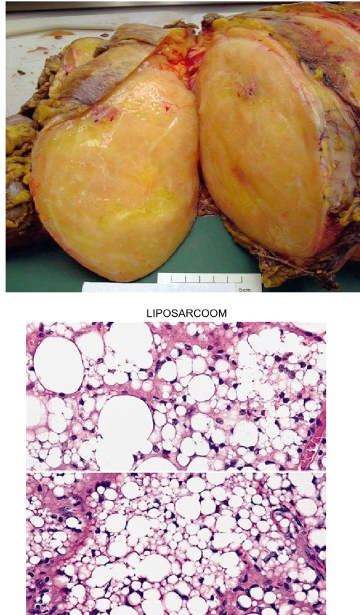 <ul><li><p>lipoom</p><ul><li><p>frequente goedaardige tumor die ontstaat uit witte adiposyten</p></li></ul></li></ul><p></p>