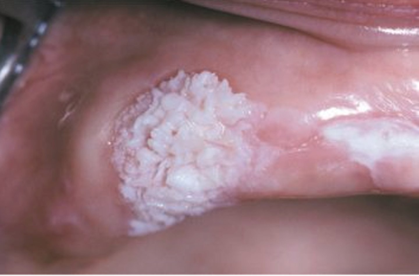 <p>diffuse white (or mixed) pebbly plaque</p><p>• common location: vestibule </p><p>• population: males over 65</p><p>• associated with smokeless tobacco</p><p>• slow growth</p>