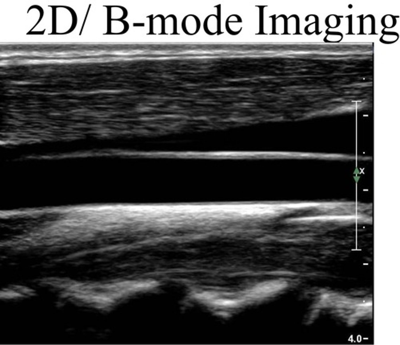 <p>Brightness-mode or Two-Dimensional mode which provides structural information utilizing different shades of gray in a two-dimensional image.</p>