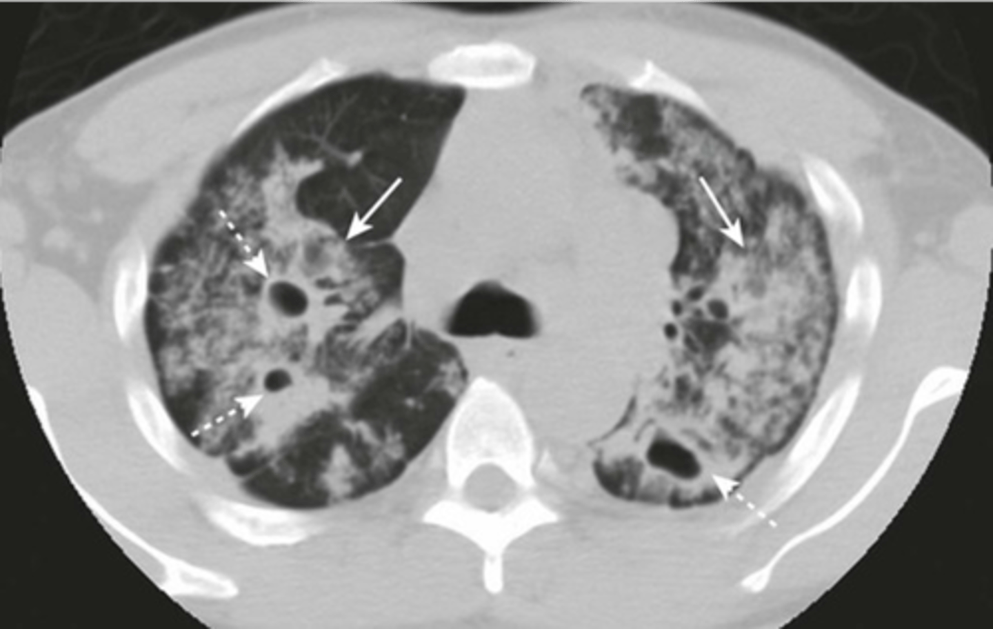 <p>-bilateral airspaces</p><p>-lucencies represetning cavities</p>