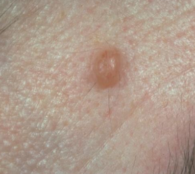 <p>elevated, solid lesion on the skin that is less than 1 centimeter in diameter. </p>