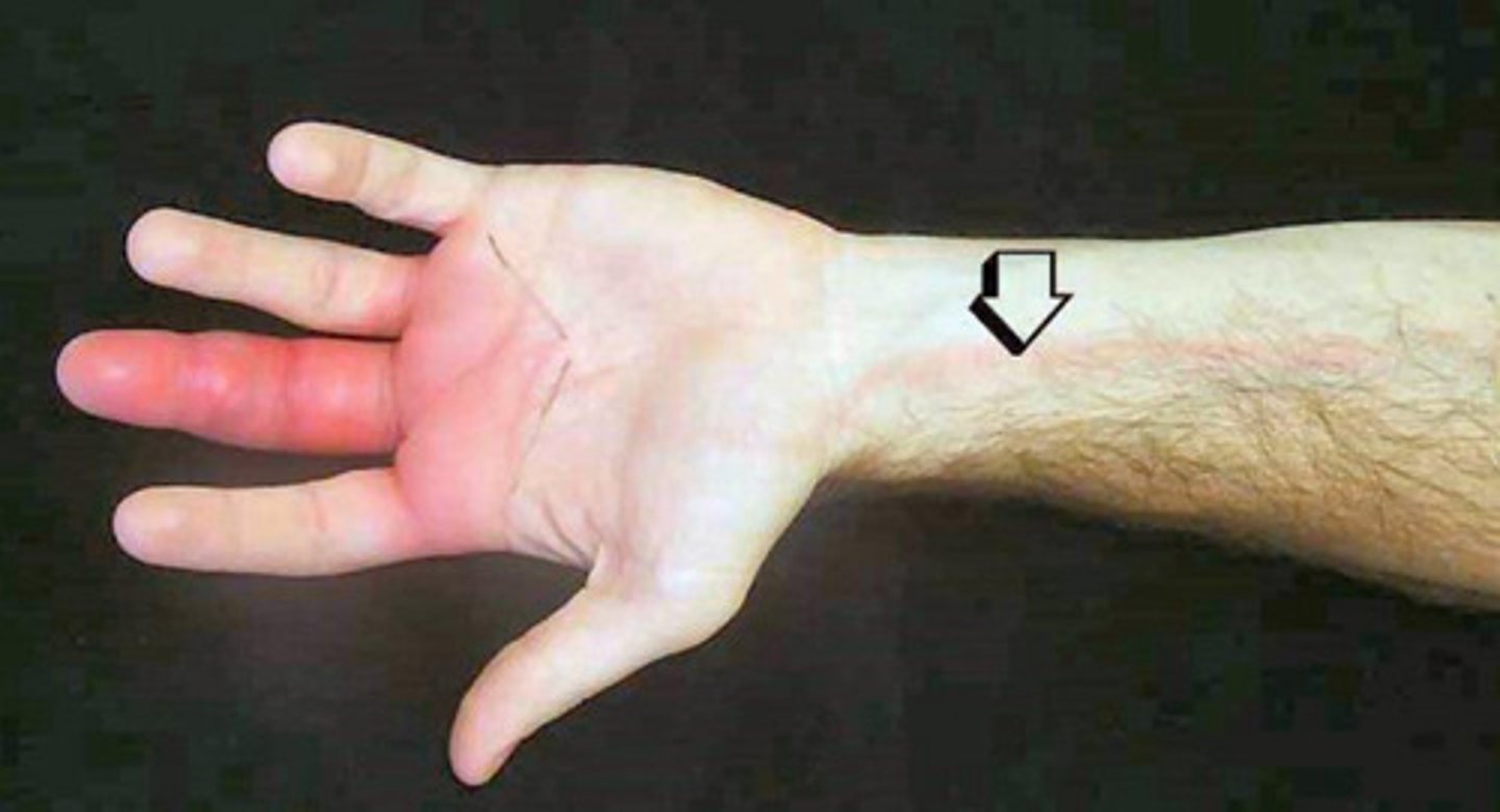 <p>Lymphangitis</p>