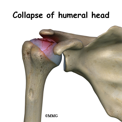 <p>Rounded, articular prjection supported by a neck (___ of hummerus)</p>