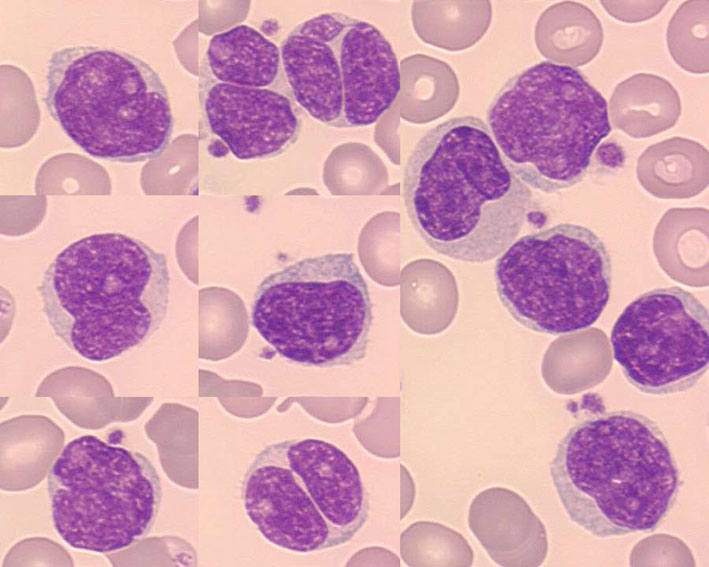 <p>Dolazi do nakupljanja mantle cells (velikih Ly B koji imaju bilobuliranu jezgru) u LČ </p>