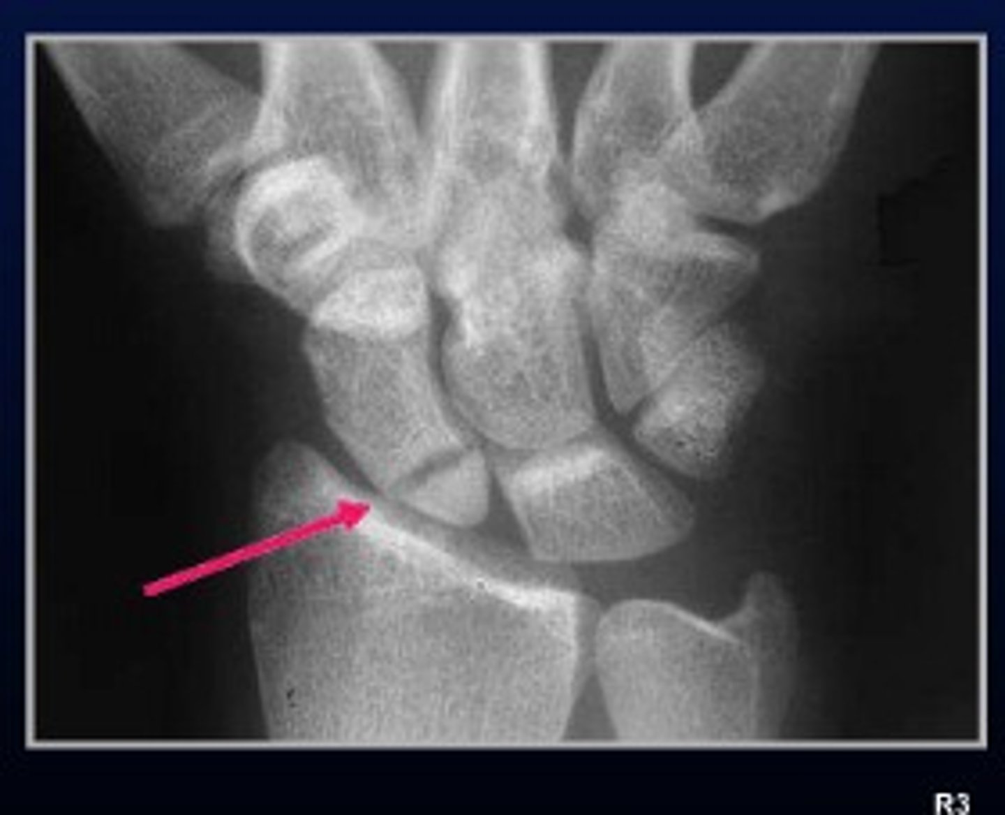 <p>Most commonly fractured carpal bone</p><p>Presents with pain, tenderness of anatomical snuffbox, pain on axial loading on thumb</p><p>Caused by FOOSH </p>