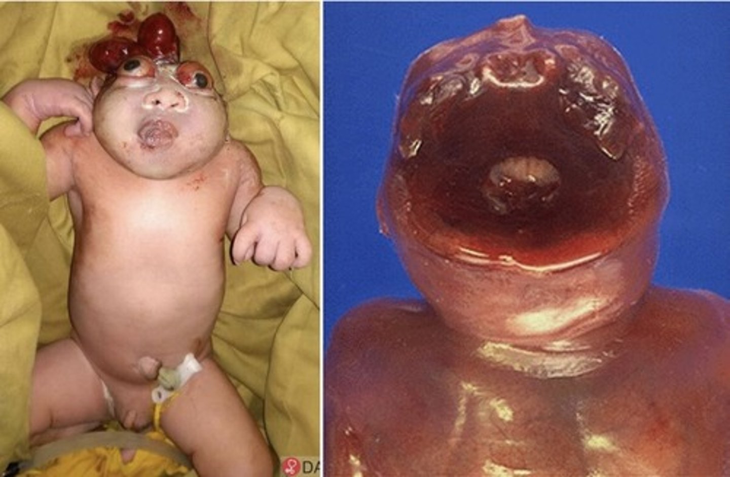 <p>Lack of calvaria</p><p>Destruction of brain tissue</p>