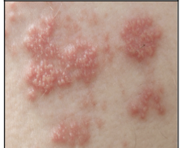 <p>Infection with the virus herpes; involves vesicles, erythema, edema, and pain.Shingles is from herpes varicella-zoster. The lesions occur along a dermatome (an area of skin  \n associated with a specific spinal nerve that goes to the spinal cord).</p>