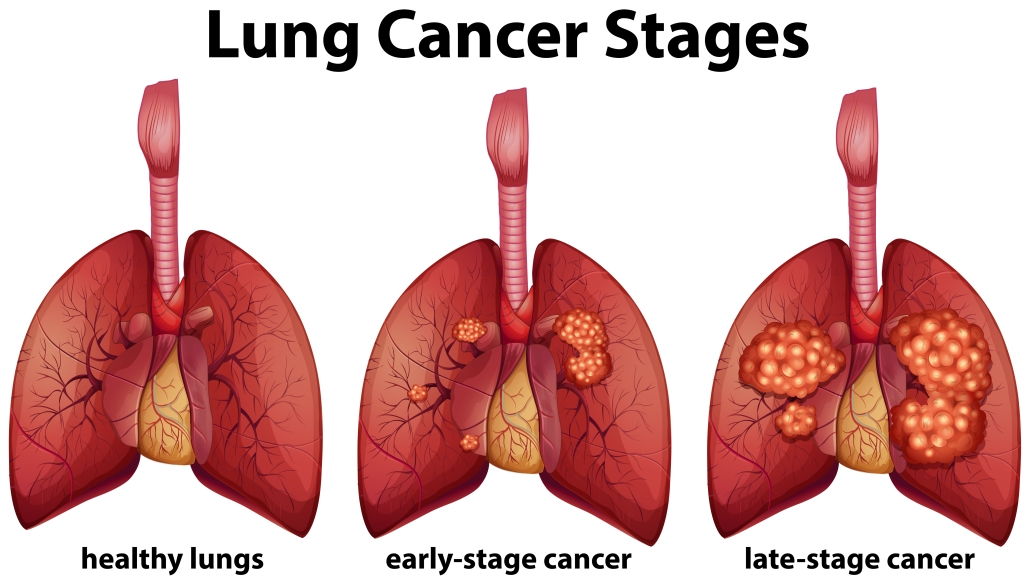 <ul><li><p>Third most common cancer in the U.S.</p></li><li><p>Occurs most often in people who smoke</p></li><li><p><span>Two major types are small cell lung cancer and non-small cell lung cancer</span></p><ul><li><p>non-small cells behave similarly whereas small cell lung cancer spreads more rapidly and usually starting in the bronchi before metastasizing</p></li></ul></li><li><p><span>Symptoms include cough (often with blood), dull or sharp pain in the chest or ribs, wheezing, unexplained weight loss, shortness or breath, difficulty breathing</span></p></li></ul>