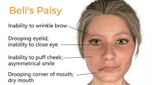 <p>acute unilateral facial weakness </p>