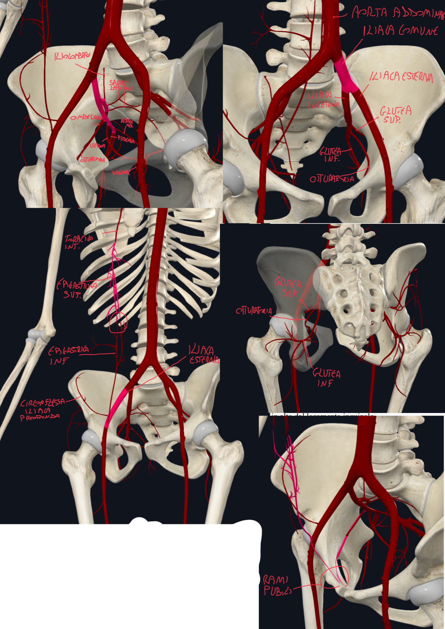<p>La vascolarizzazione dell’arto inferiore è dovuta ai rami dell’ARTERIA ILIACA INTERNA e dell’ARTERIA FEMORALE</p><p>ARTERIA ILIACA INTERNA:</p><ul><li><p>L’aorta addominale discendente termina dividendosi in un’arteria iliaca comune dx e sx, ciascuna delle quali si divide a sua volta in un’arteria iliaca interna ed esterna</p></li><li><p>Quella interna, nella cavita pelvica, invia rami destinati alla regione glutea e coscia mediale prossimale:</p><ul><li><p>ARTERIA GLUTEA SUPERIORE E INFERIORE: attraversano il grande forame ischiatico rispettivamente sopra e sotto il piriforme accompagnando i nervi glutei</p></li><li><p>ARTERIA OTTURATORIA: raggiunge la parte mediale della coscia prossimale attraversando il canale otturatorio.</p><ul><li><p>Origina l’arteria acetabolare che va nell’incisura acetabolare per vascolarizzare la testa del femore </p></li><li><p>e rami pubici</p></li></ul></li><li><p>Altri rami della iliaca interna: iliolombare, sacrali laterali, pudenda interna, ombelicale, rettale mediale, uterina e vaginale (nella donna), deferenziale (nell’uomo)</p></li></ul></li></ul><p>ARTERIA ILIACA ESTERNA:</p><ul><li><p>Ha calibro maggiore della interna e prima di lasciare la cavità addomino-pelvica origina l’ARTERIA EPIGASTRICA INFERIORE e l’ARTERIA CIRCONFLESSA ILIACA PROFONDA per la parete anterolaterale dell’addome</p><ul><li><p>La epigastrica inferiore si anastomizza con l’epigastrica superiore della toracica interna all’interno della guaina del muscolo retto dell’addome</p></li><li><p>I rami pubici della epigastrica inferiore si anastomizzano con quelli dell’arteria otturatoria (anastomosi corona mortis, di rilevanza clinica perché la sua lesione durante interventi di ernia inguinale o femorale causa importante sanguinamento)</p></li></ul></li><li><p>Superato lo spazio retroinguinale, diventa ARTERIA FEMORALE</p></li></ul><p></p>