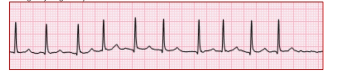 <p>Afib with rapid ventricular response</p>