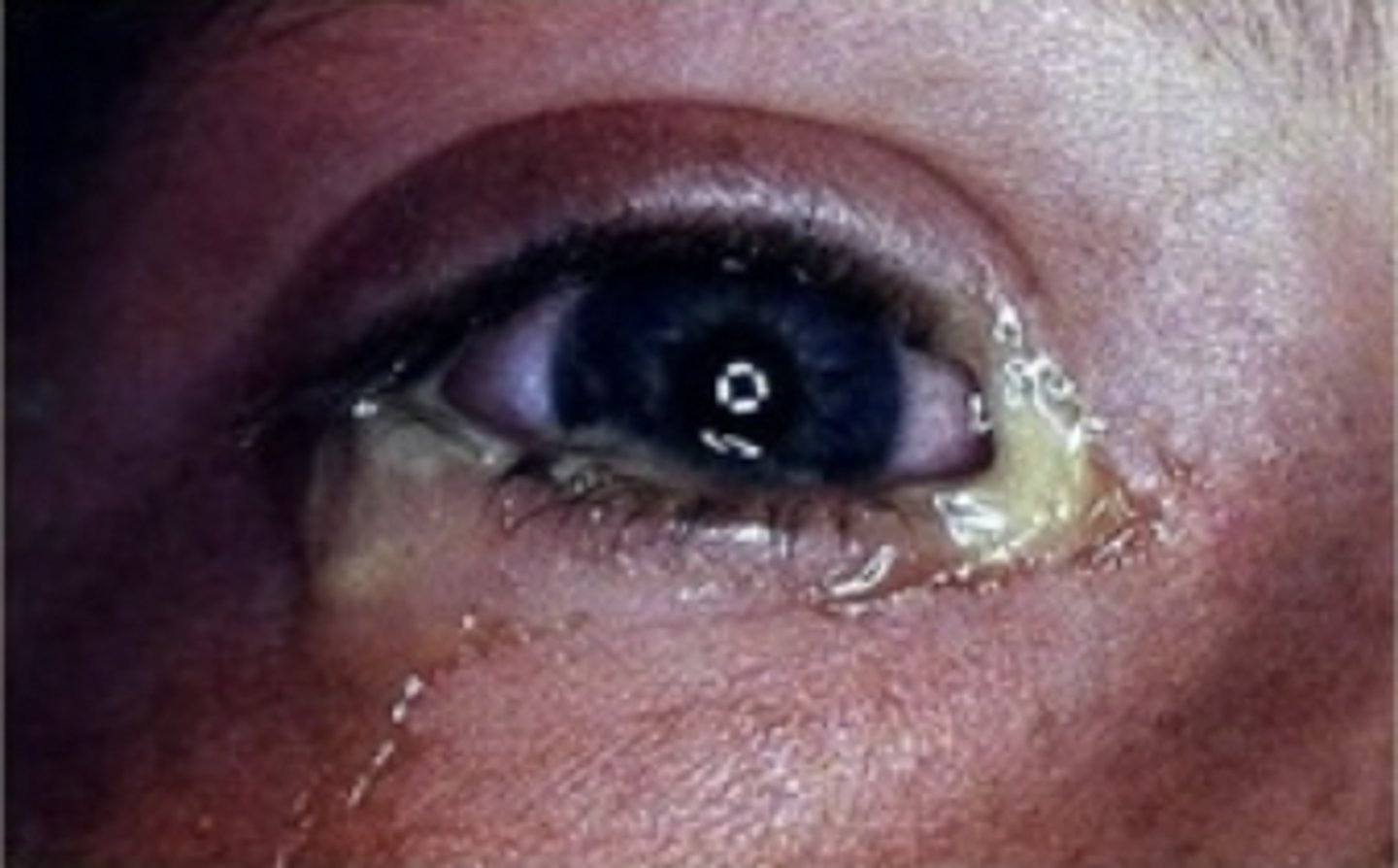 <p><u>Etio</u>: <strong><mark data-color="#eef300" style="background-color: #eef300; color: inherit">S. Aureus, S. Pneumoniae, H. Influenzae, M. Catarrhalis</mark></strong></p><p><u>Considerations</u>: Gonorrhoeae conjunctivitis</p><p><u>S&amp;S</u>: <strong>sudden</strong> onset, <strong>mucopurulent</strong> discharge, FB sensation, no blurring of vision, mild discomfort, may be <strong>unilateral or bilateral</strong></p><p><u>Tx:</u> <strong><mark data-color="#fcf506" style="background-color: #fcf506; color: inherit">Erythromycin ophthalmic 0.5% ointment</mark></strong>, warm compress, referral - ophthalmologist if not improved</p>