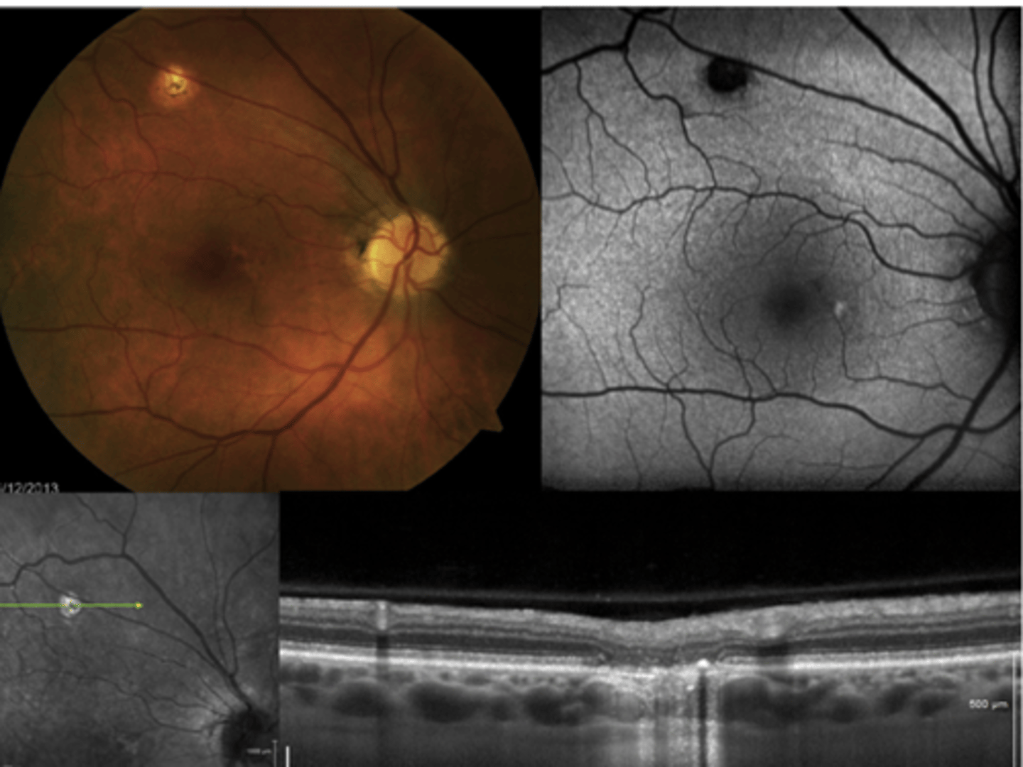 <p>hyperF bc loss of RPE = can see choroid blood below</p>
