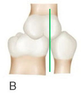 <p>angle class __ molar relationship</p>
