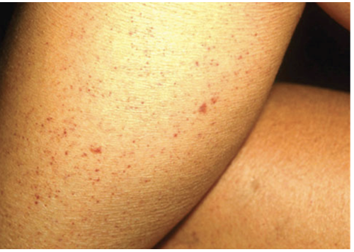 <p><span>How would you document this skin finding?</span></p><p></p>