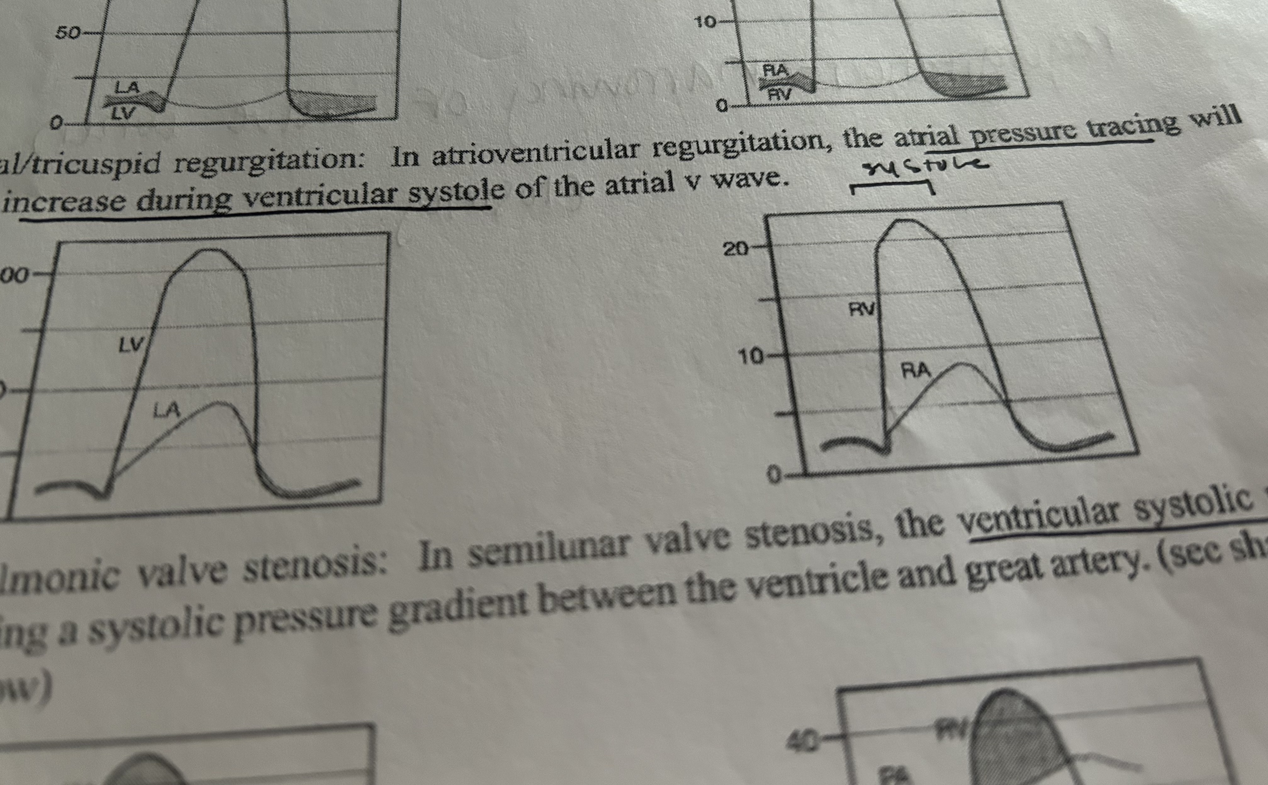<p>Mitral/tricuspid regurgitation</p>