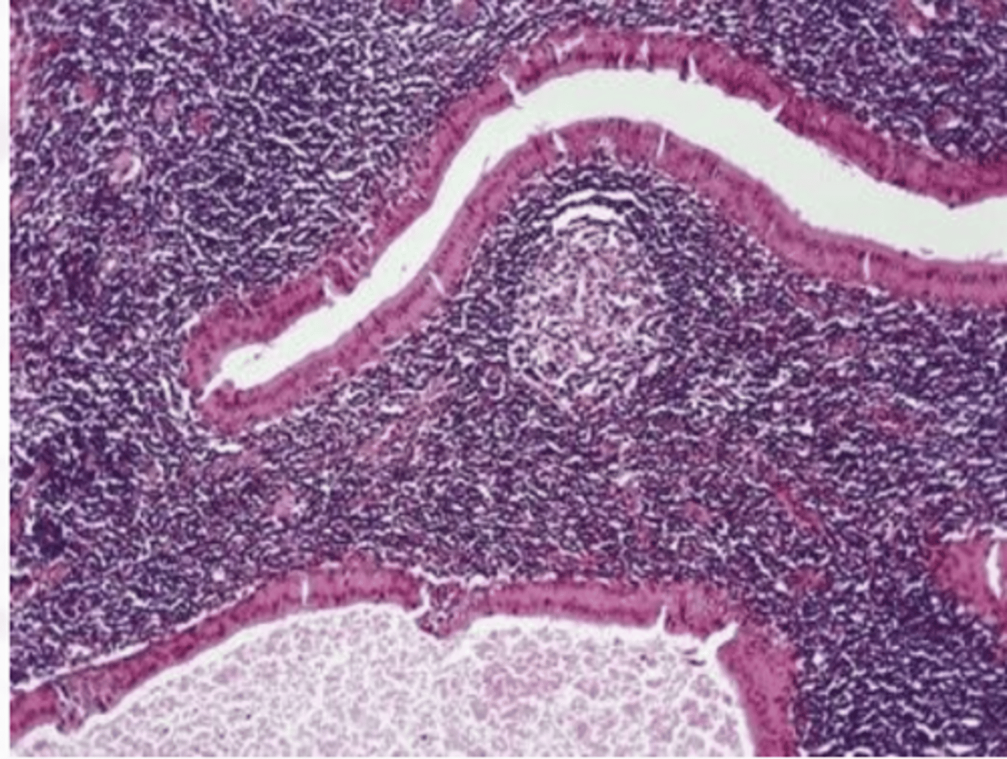 <p>These histologic characteristics are indicative of what oral pathology?</p><p>Cyst lined by uniform rows of oncocytic (pink) cells</p><p>The lining is papillary in appearance</p><p>The cyst call is composted of abundant lymphocytes (purple)</p>